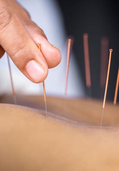 Acupuncture & Naturopathy